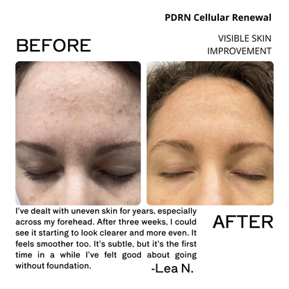 Before and after comparison of skin improvement using PDRN Cellular Renewal, with a testimonial from Lea N.